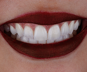 Principais benefícios das Lentes de contato dental em Porcelana.